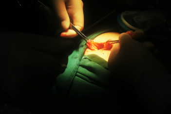 妇科开展单孔腹腔镜