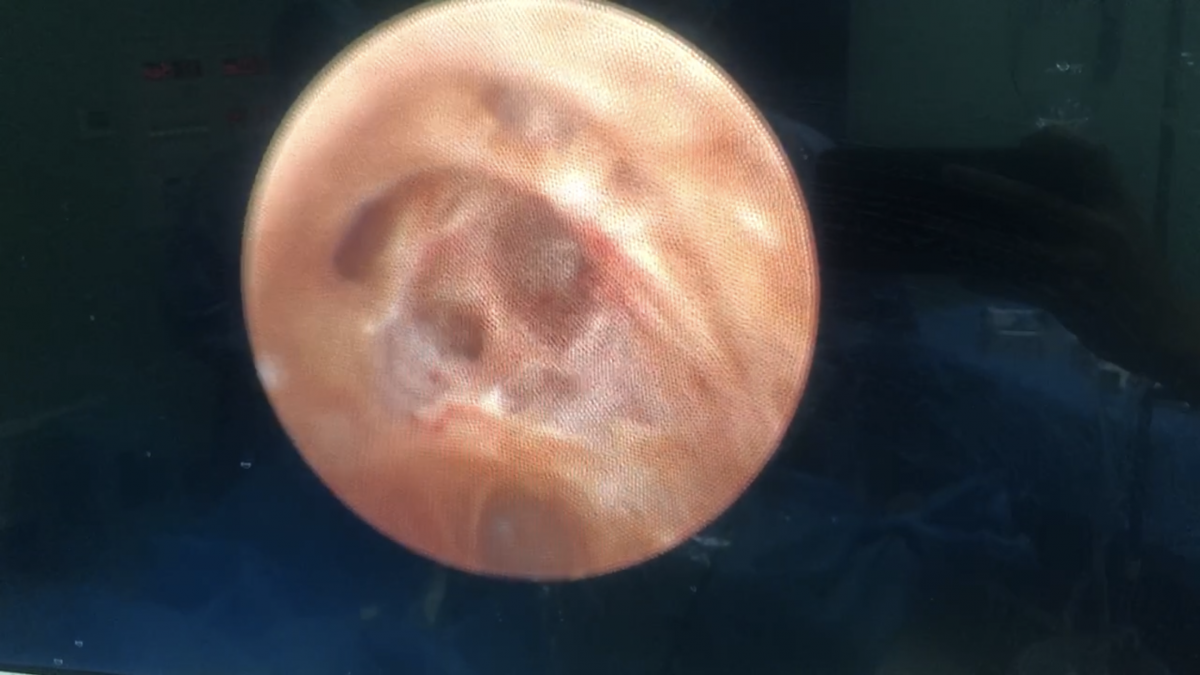 我院泌尿外科团队成功完成一例精囊镜探查术