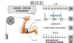 【红医科普】神经电生理检查，你了解吗？