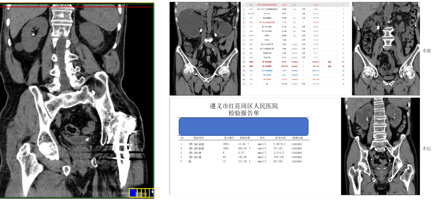 输尿管结石微创治疗病例影像