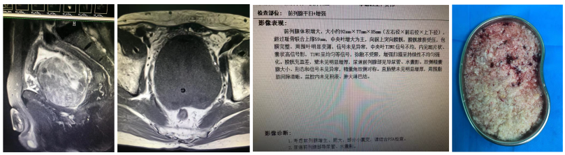 巨大前列腺增生病例影像