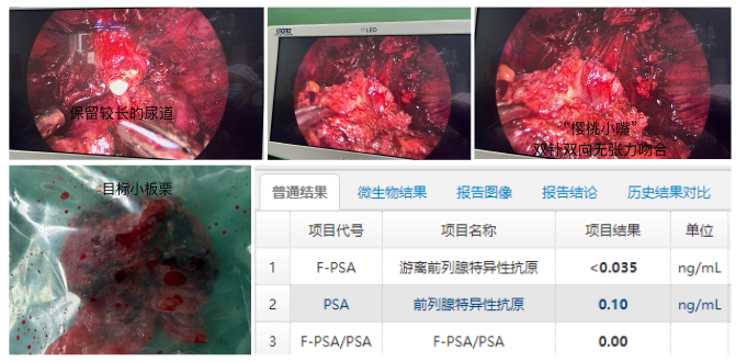 前列腺癌早筛确诊治疗随访流程