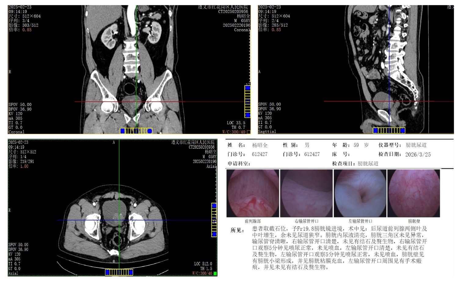 非肌层浸润性膀胱癌全流程管理