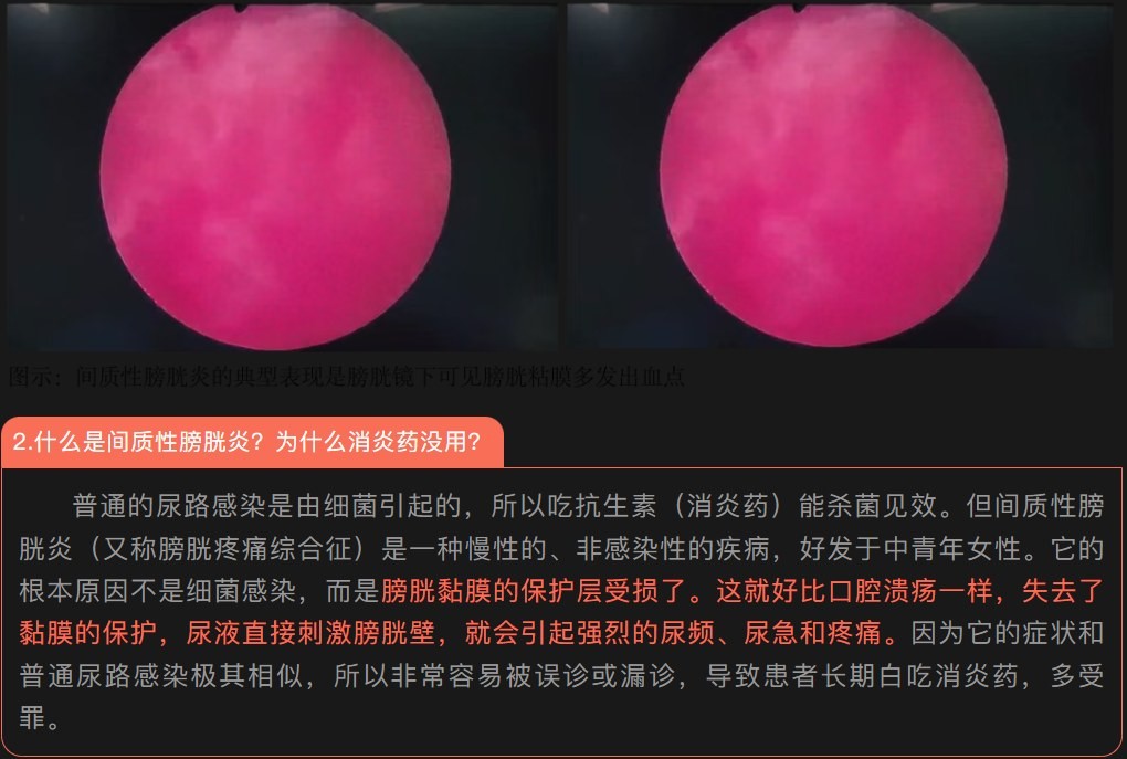 顽固性尿频尿痛膀胱镜表现