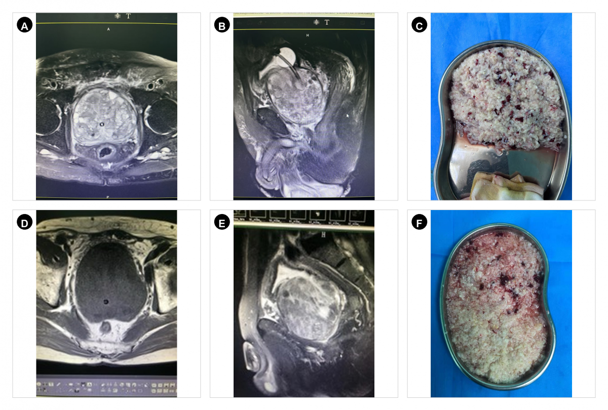 高龄巨大前列腺增生患者 HoLEP 治疗 MRI 与剜除组织病例拼图