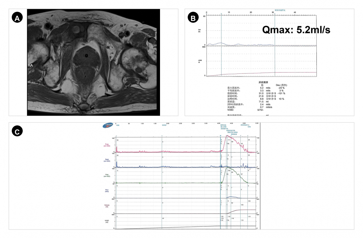 前列腺不大但膀胱出口梗阻明显病例 MRI 尿流率与尿动力学 A-C 拼图